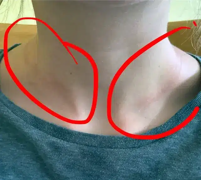 allergie bijoux